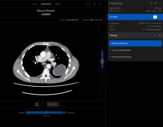 Foto: Offene Imaging-AI-Plattform und starke Daten im CT-Thorax...
