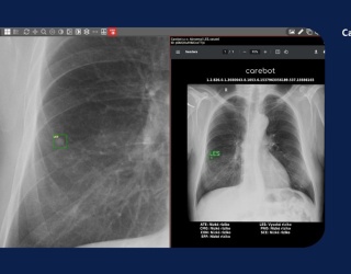 Foto: Med AI Solutions | Carebot AI CXR