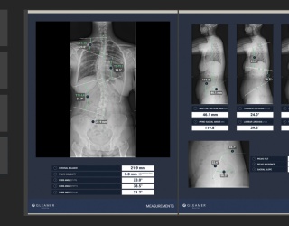 Foto: Gleamer | BoneMetrics