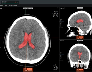 Foto: Coreline | aview NeuroCAD
