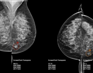 Foto: Injecto Med | Screenpoint Medical · Transpara...