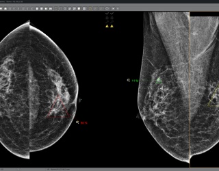 Foto: Visus Health |  JiveX Mammography