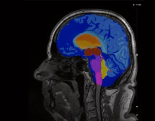 Foto: Siemens Healthineers | AI-Rad Companion Brain MR...