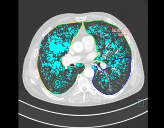Foto: Siemens Healthineers | AI-Rad Companion Chest CT...