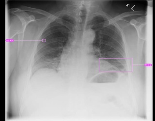 Foto: Siemens Healthineers | AI-Rad Companion Chest X-ray...