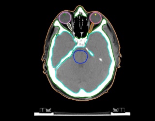 Foto: Siemens Healthineers | AI-Rad Companion Organs RT...