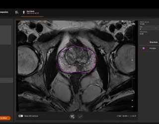 Foto: Siemens Healthineers | AI-Rad Companion Prostate MR...