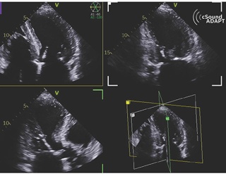 Foto: GE HealthCare | cSound ADAPT