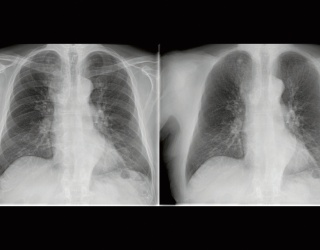Foto: Philips | ClearRead Xray Bone Suppress (Riverain Technologies)...