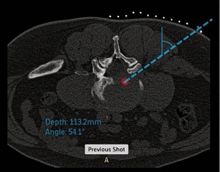 Foto: Philips | Precise Intervention