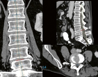 Foto: Philips | Precise Rib / Precise Spine
