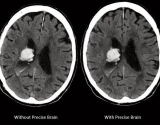 Foto: Philips | Precise Brain