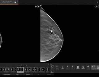 Foto: Siemens Healthineers | Mammovista b.Smart...