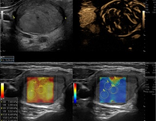 Kopf-Hals-Tumoren: Ultraschall als erstes Mittel der Wahl zur Diagnose