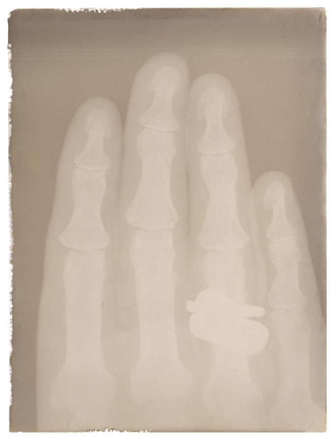 Röntgenaufnahme einer Hand,6. Juni 1896 (C)DRG