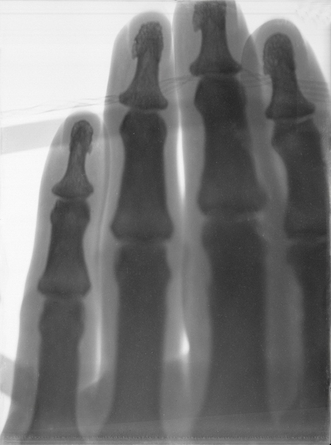 Röntgenaufnahme einer Hand,21. Mai 1896 (C)DRG