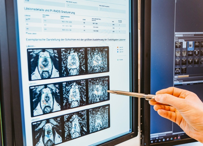 Ausmessung der Prostata mit mdprostate