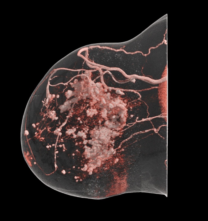 Multizentrischer Tumor der rechten Brust