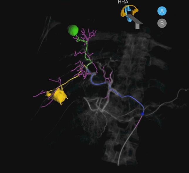 My Embolization Guide
