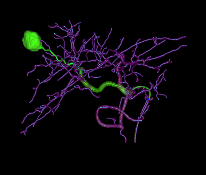 MyEmbolization Guide