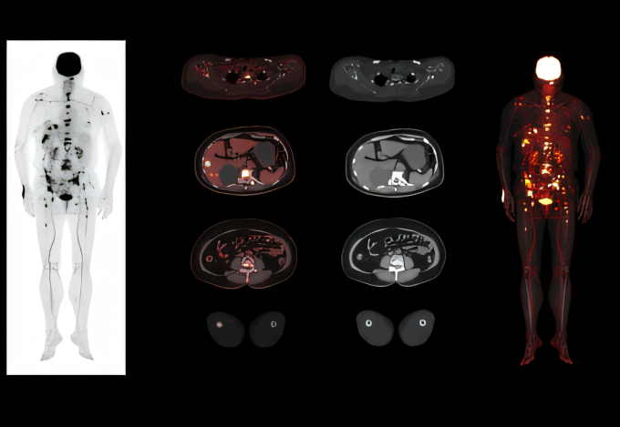 PET/CT
