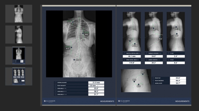 Foto: Gleamer | BoneMetrics