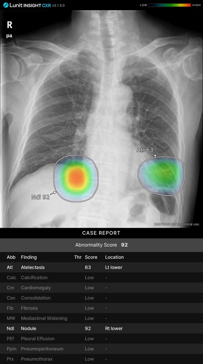 Foto: Lunit | INSIGHT CXR