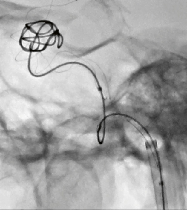 Gecoiltes Aneurysma