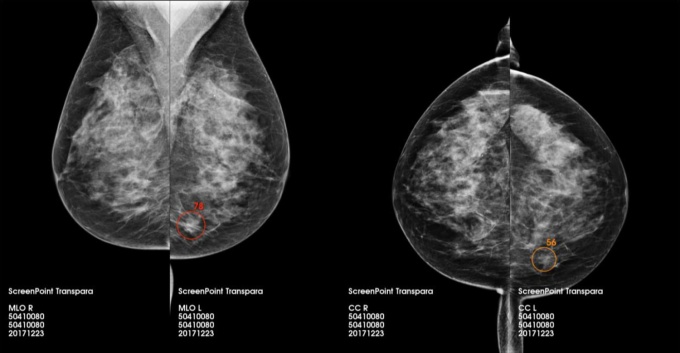 Foto: Injecto Med | Screenpoint Medical · Transpara...