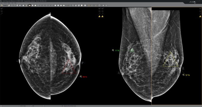 Foto: Visus Health | JiveX Mammography