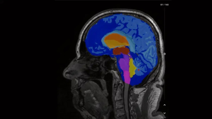 Foto: Siemens Healthineers | AI-Rad Companion Brain MR...