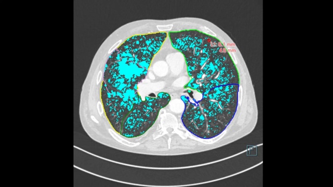 Foto: Siemens Healthineers | AI-Rad Companion Chest CT...