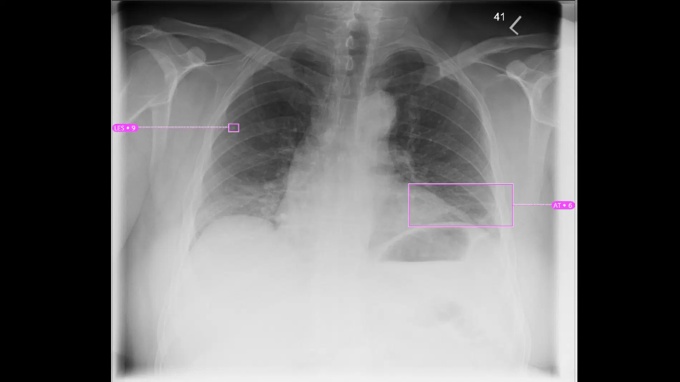 Foto: Siemens Healthineers | AI-Rad Companion Chest X-ray...