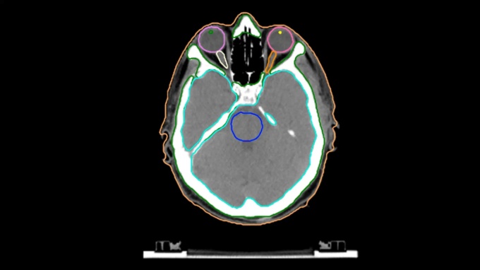Foto: Siemens Healthineers | AI-Rad Companion Organs RT...