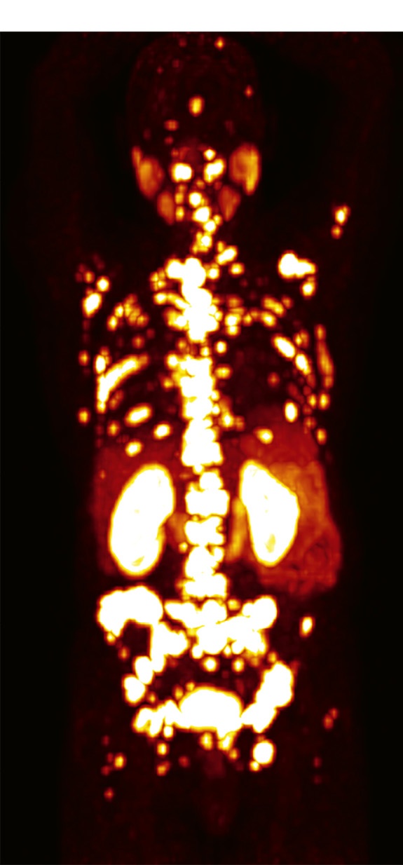 Vor der Behandlung PET MIP 68Ga-PSMA-J591