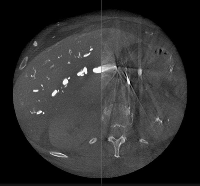 Foto: GE HealthCare | ClearRecon DL*