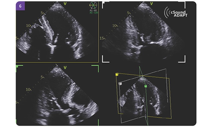 Foto: GE HealthCare | cSound ADAPT