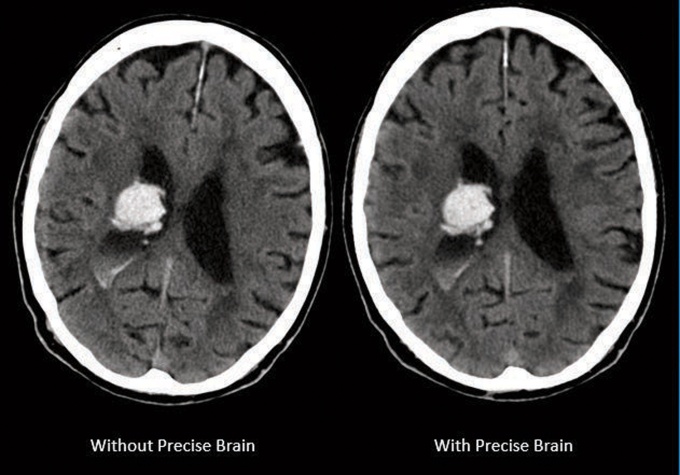 Foto: Philips | Precise Brain