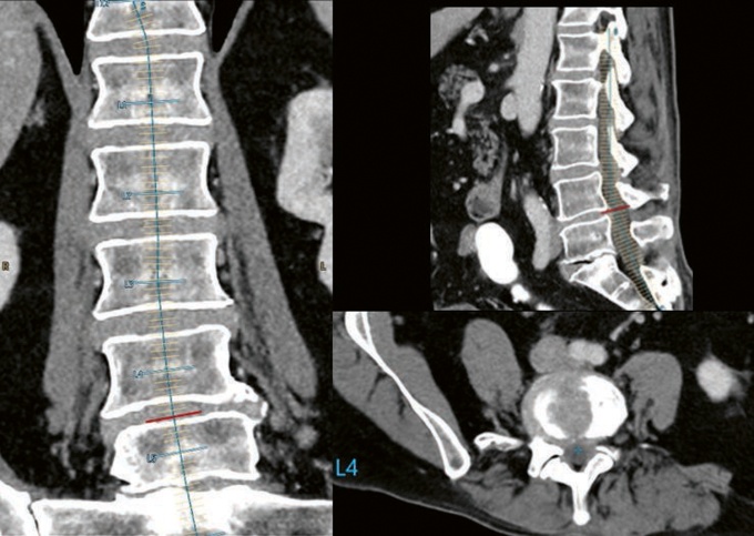 Foto: Philips | Precise Rib / Precise Spine