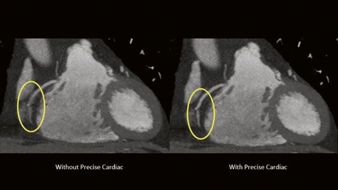 Foto: Philips | Precise Cardiac