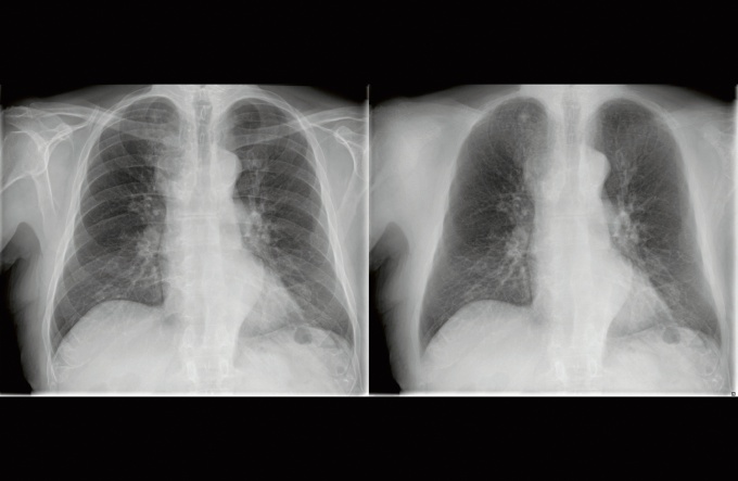 Foto: Philips | ClearRead Xray Bone Suppress (Riverain Technologies)...